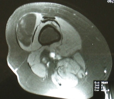 Lipoma MRI 3